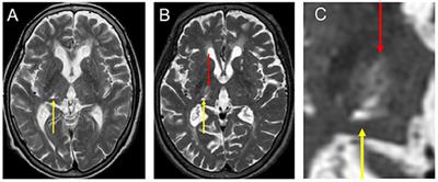 A case report: Dual-lead deep brain stimulation of the posterior subthalamic area and the thalamus was effective for Holmes tremor after unsuccessful focused ultrasound thalamotomy